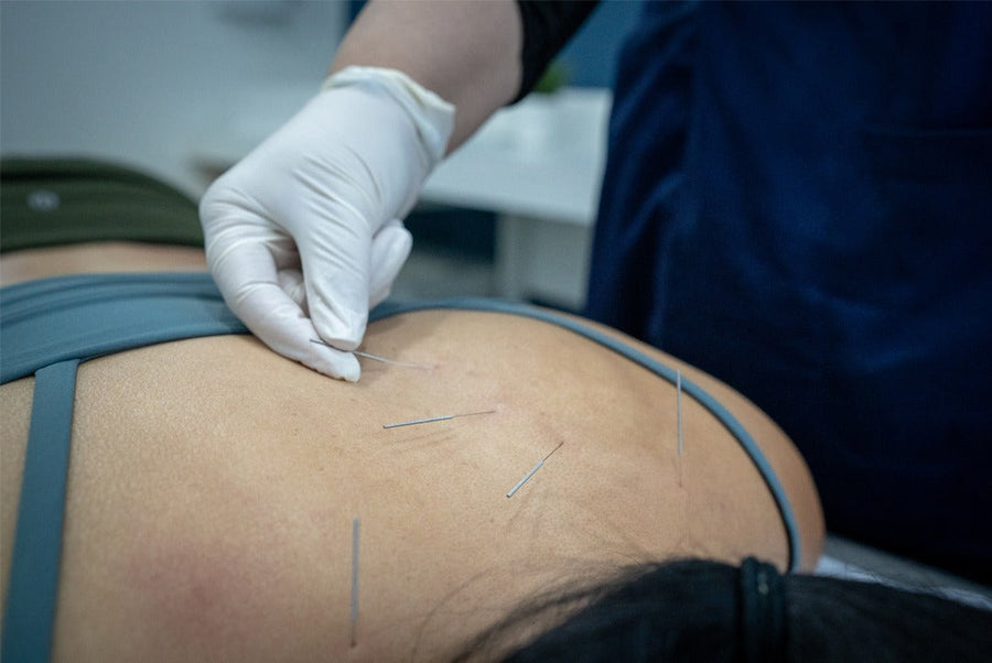 Understanding dry needling: physiotherapy article image