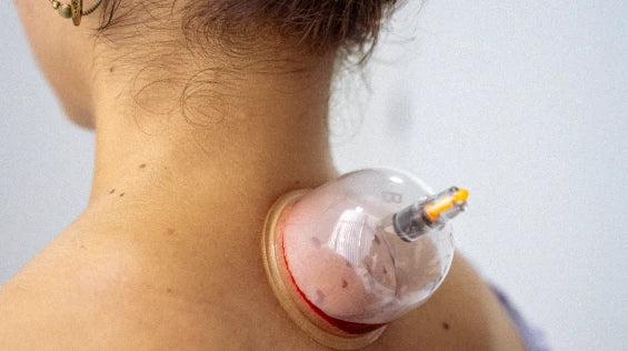 WET CUPPING OR HIJAMA