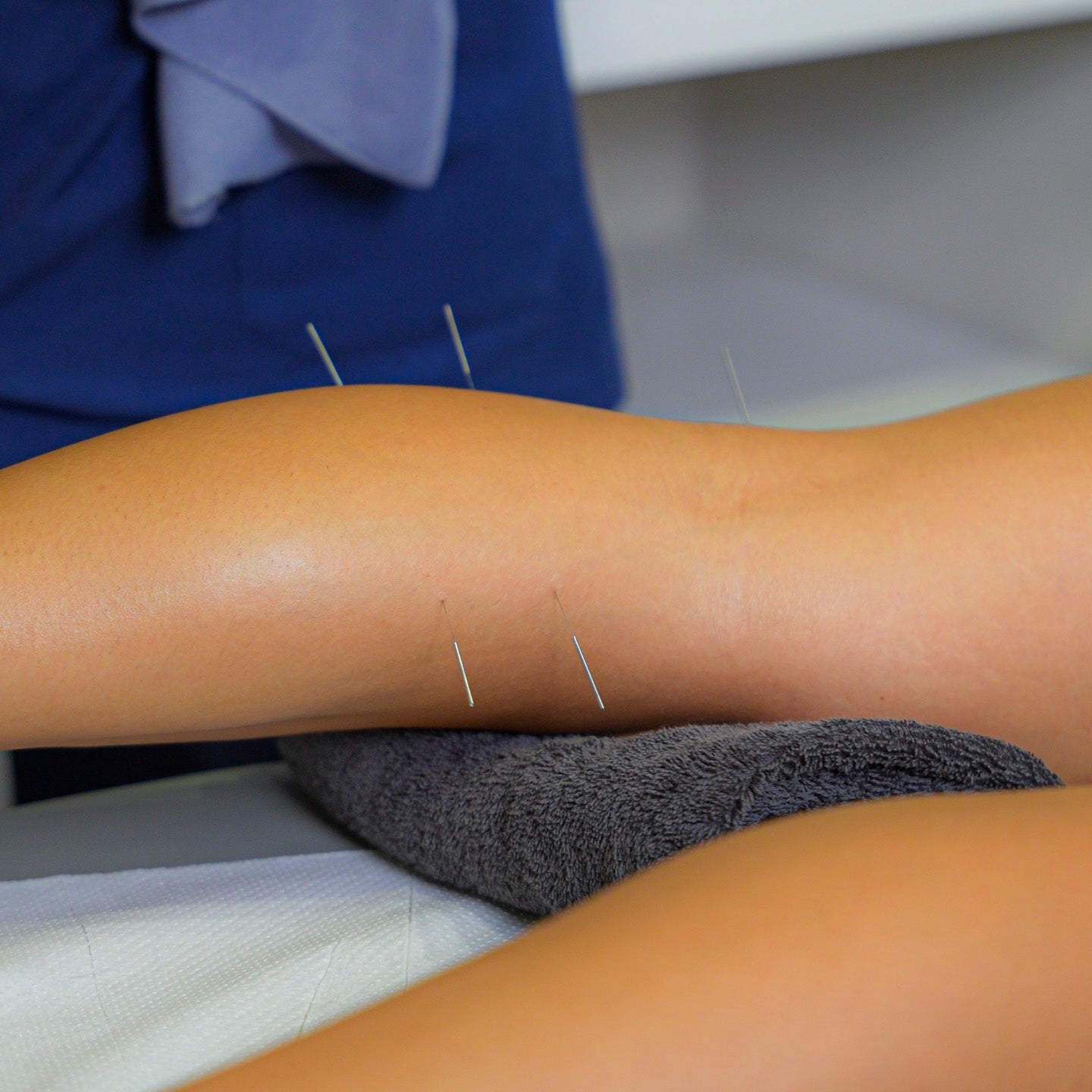 Who can benefit from dry needling therapy?