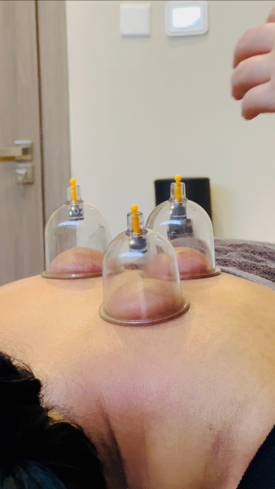 Dry cupping process at Healthagon