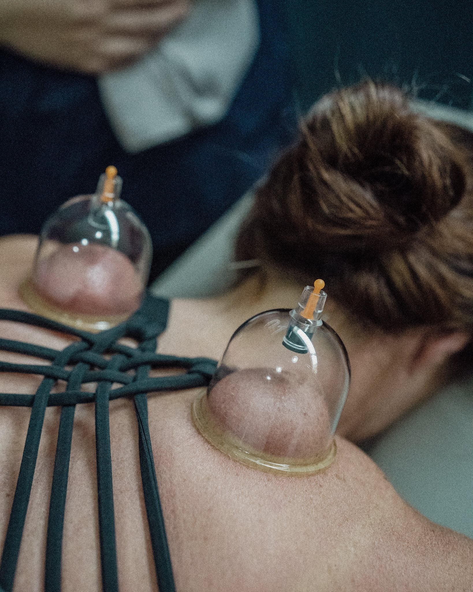 Conditions Benefited by Dry Cupping