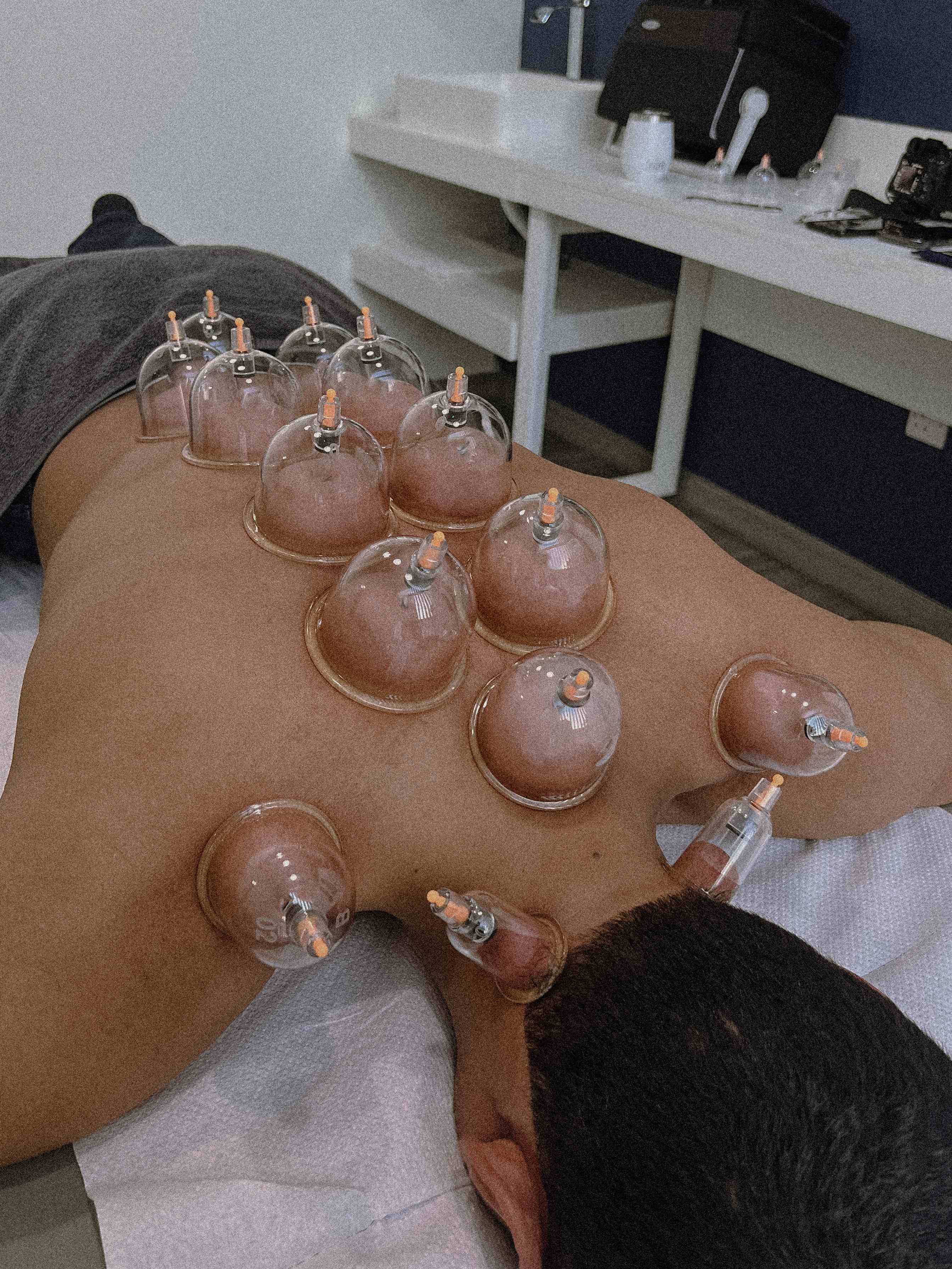 How can dry cupping therapy support your health?