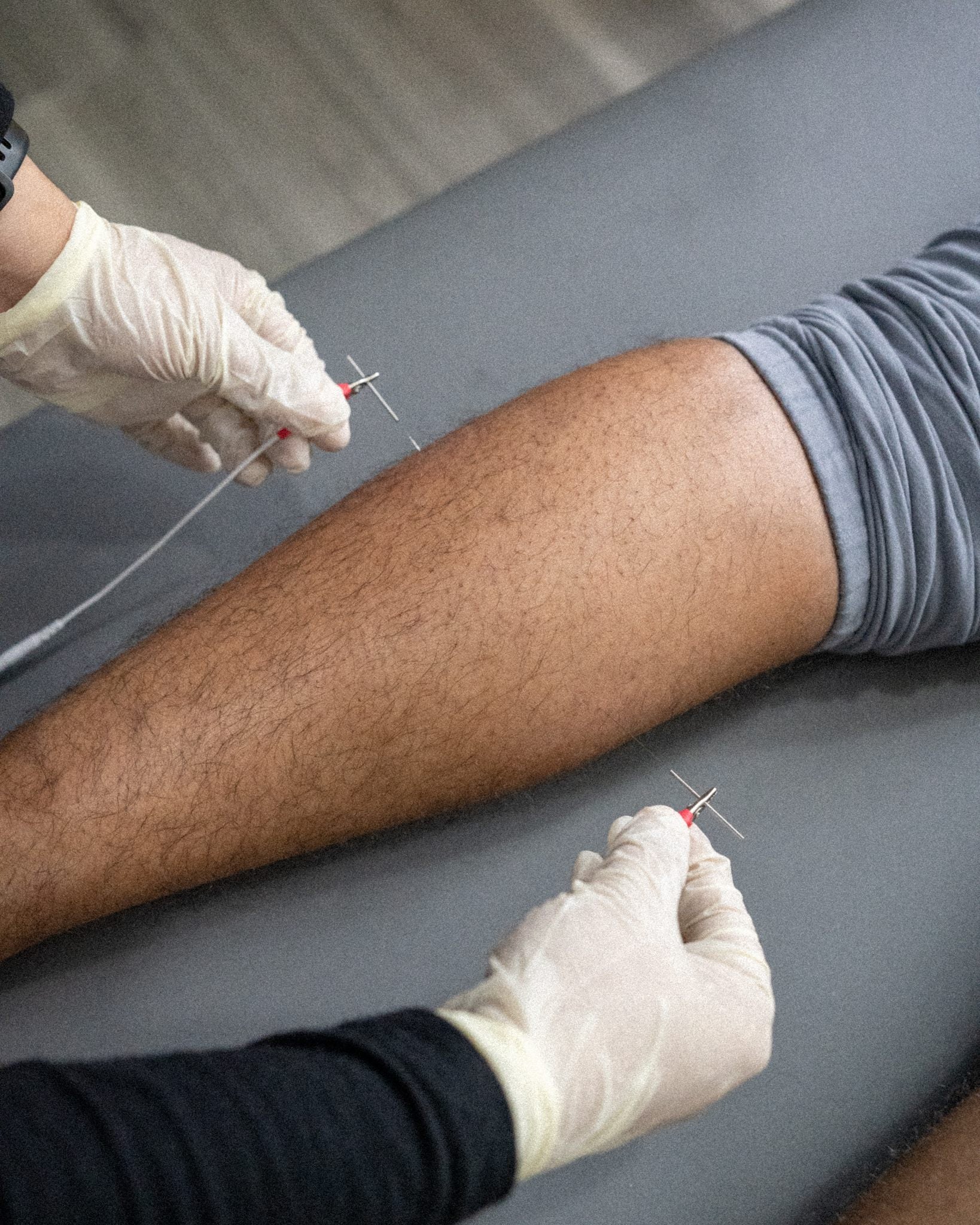 Conditions Benefited by Dry Needling