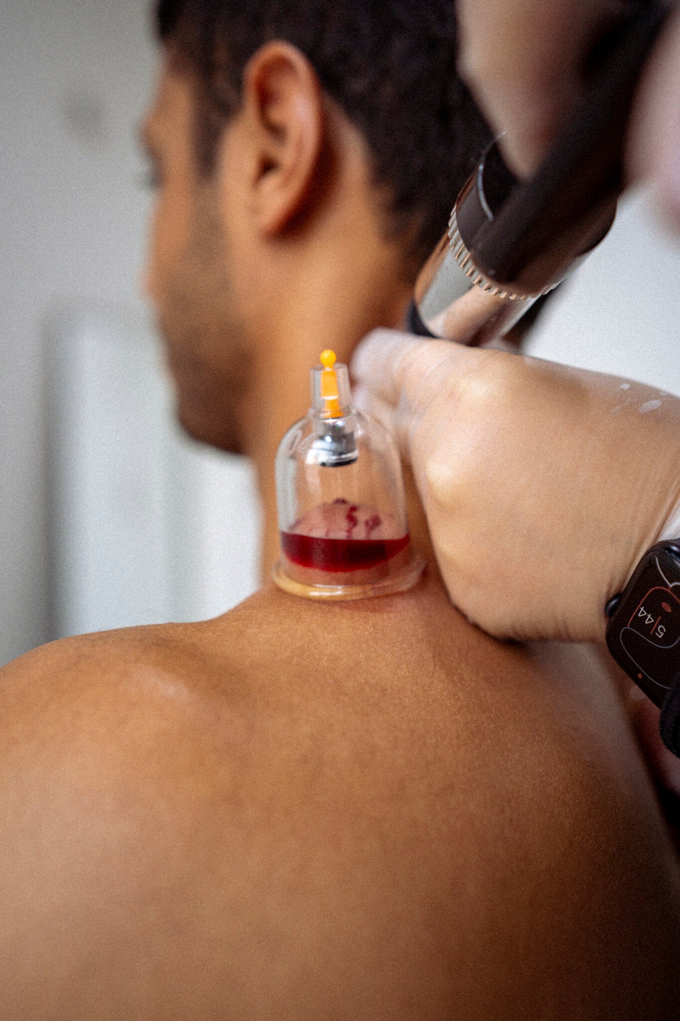 How can Hijama elevate your overall well-being?