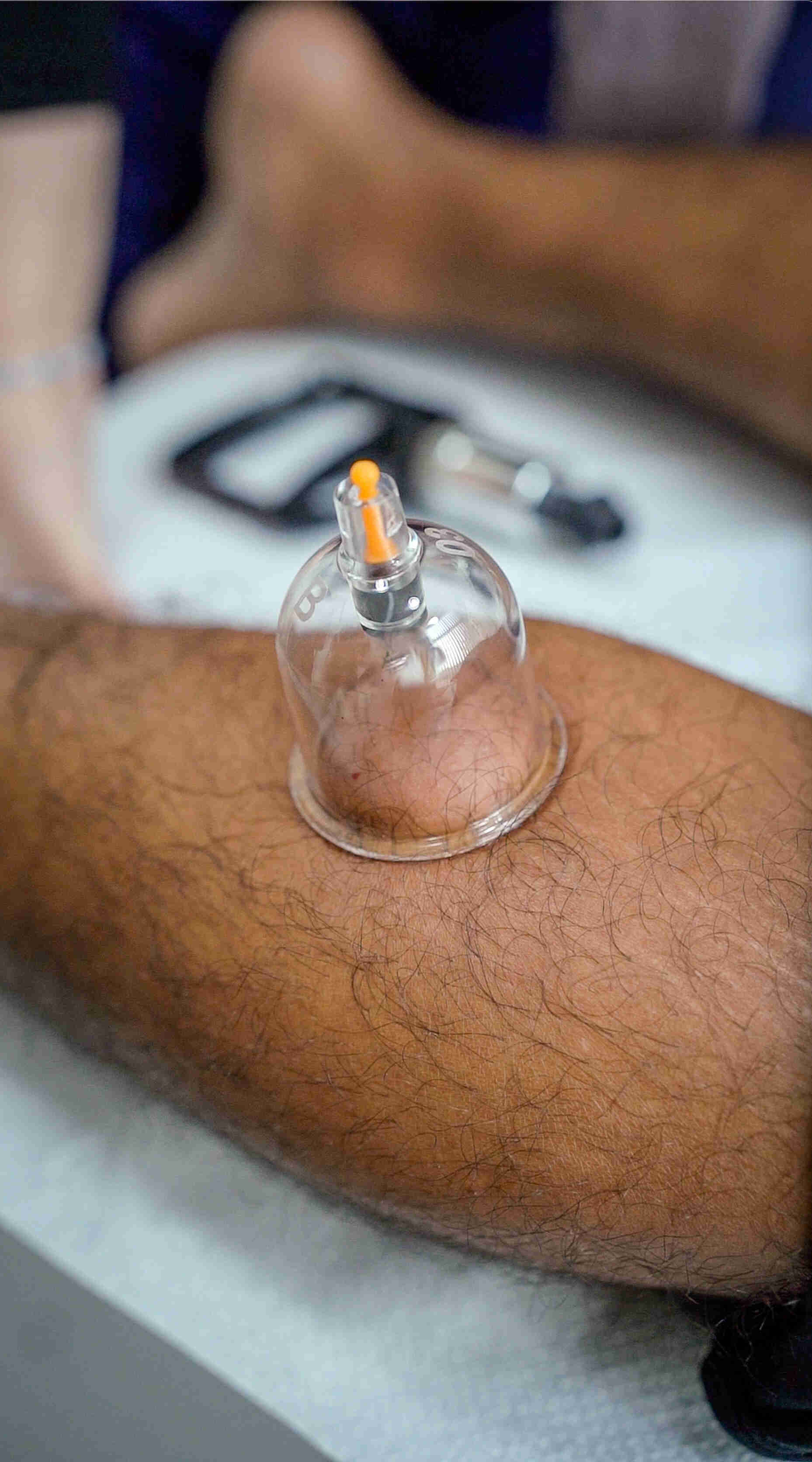 Conditions Benefited by Hijama